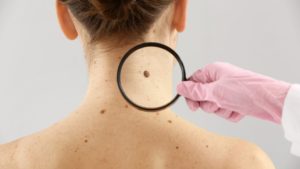 Melanomul, al patrulea cel mai frecvent cancer la persoanele tinere