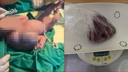 Viață salvată la doar câteva ore de la naștere