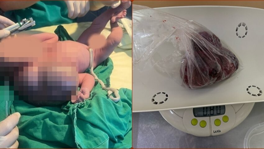 Viață salvată la doar câteva ore de la naștere