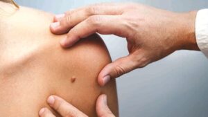 Terapia cu ARNm, rezultate promițătoare în lupta cu melanomul