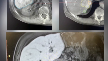Premieră medicală: un pacient cu cancer hepatic, tratat printr-o procedură minim invazivă